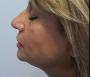 Facelift Before and After Pictures Washington, DC