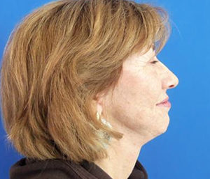 Facelift Before and After Pictures Washington, DC