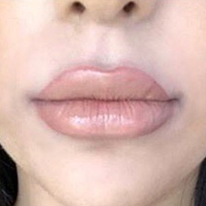 Lip Enhancement Before and After Pictures Washington, DC