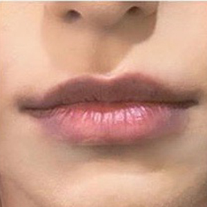 Lip Enhancement Before and After Pictures Washington, DC