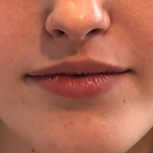 Lip Enhancement Before and After Pictures Washington, DC