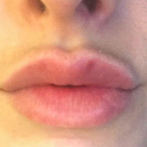 Lip Enhancement Before and After Pictures Washington, DC