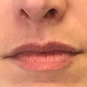 Lip Enhancement Before and After Pictures Washington, DC