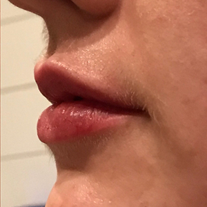 Lip Enhancement Before and After Pictures Washington, DC