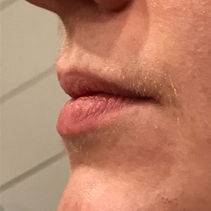 Lip Enhancement Before and After Pictures Washington, DC