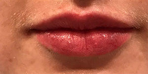 Lip Enhancement Before and After Pictures Washington, DC