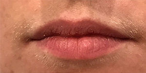 Lip Enhancement Before and After Pictures Washington, DC