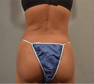 Liposuction Before and After Pictures Washington, DC