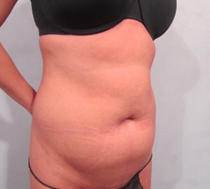 Liposuction Before and After Pictures Washington, DC