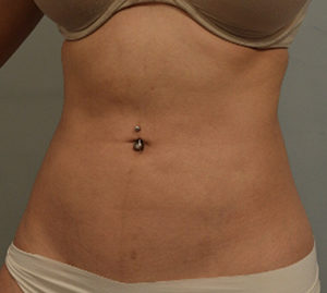 Liposuction Before and After Pictures Washington, DC