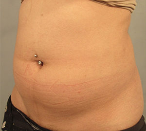 Liposuction Before and After Pictures Washington, DC