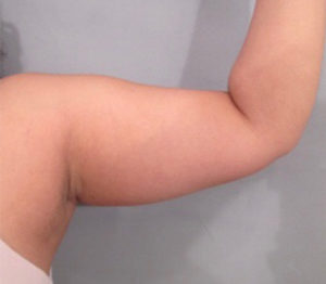 Liposuction Before and After Pictures Washington, DC