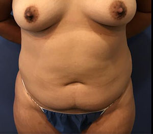 Liposuction Before and After Pictures Washington, DC