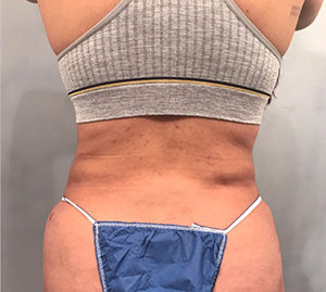 Liposuction Before and After Pictures Washington, DC