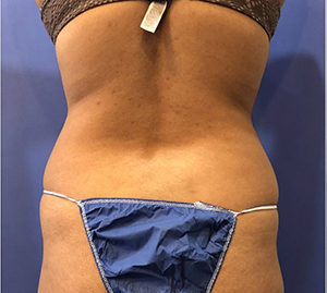 Liposuction Before and After Pictures Washington, DC