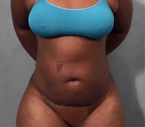 Liposuction Before and After Pictures Washington, DC