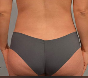 Liposuction Before and After Pictures Washington, DC