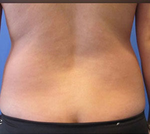 Liposuction Before and After Pictures Washington, DC