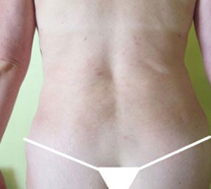 Liposuction Before and After Pictures Washington, DC