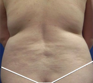 Liposuction Before and After Pictures Washington, DC