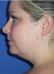 Laser Liposuction Before and After Pictures Washington, DC