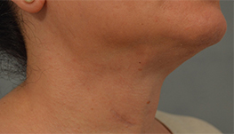 Neck Lift Before and After Pictures Washington, DC