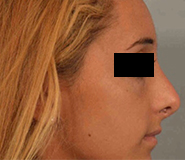 Rhinoplasty Before and After Pictures Washington, DC