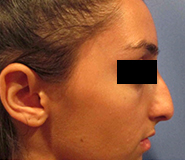 Rhinoplasty Before and After Pictures Washington, DC