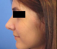 Rhinoplasty Before and After Pictures Washington, DC