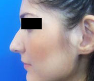 Rhinoplasty Before and After Pictures Washington, DC