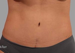 Tummy Tuck Before and After Pictures Washington, DC