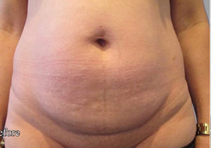 Tummy Tuck Before and After Pictures Washington, DC