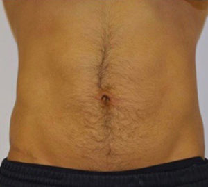 Tummy Tuck Before and After Pictures Washington, DC