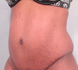 Tummy Tuck Before and After Pictures Washington, DC