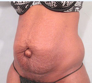 Tummy Tuck Before and After Pictures Washington, DC