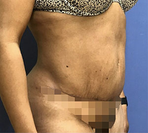 Tummy Tuck Before and After Pictures Washington, DC