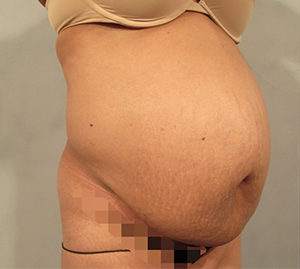 Tummy Tuck Before and After Pictures Washington, DC