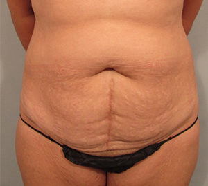 Tummy Tuck Before and After Pictures Washington, DC