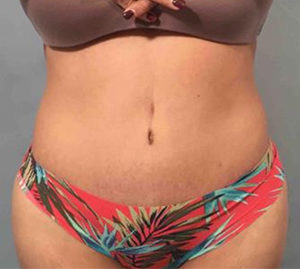 Tummy Tuck Before and After Pictures Washington, DC