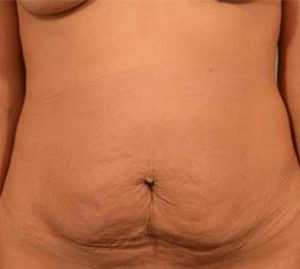 Tummy Tuck Before and After Pictures Washington, DC