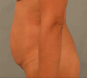 Tummy Tuck Before and After Pictures Washington, DC