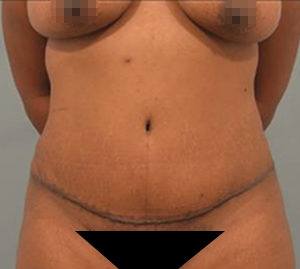 Tummy Tuck Before and After Pictures Washington, DC