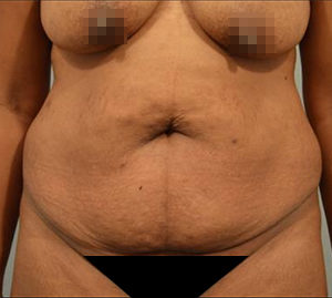 Tummy Tuck Before and After Pictures Washington, DC