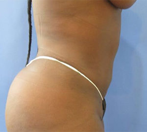 Tummy Tuck Before and After Pictures Washington, DC