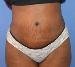 Tummy Tuck Before and After Pictures Washington, DC