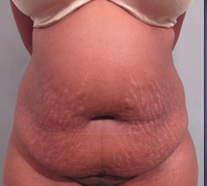 Tummy Tuck Before and After Pictures Washington, DC