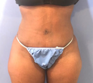 Tummy Tuck Before and After Pictures Washington, DC