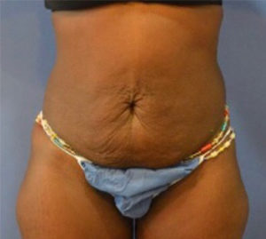 Tummy Tuck Before and After Pictures Washington, DC