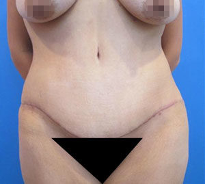 Tummy Tuck Before and After Pictures Washington, DC