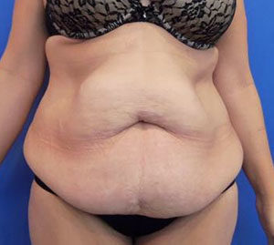 Tummy Tuck Before and After Pictures Washington, DC